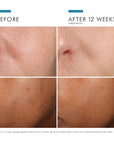 Phloretin CF with Ferulic Acid